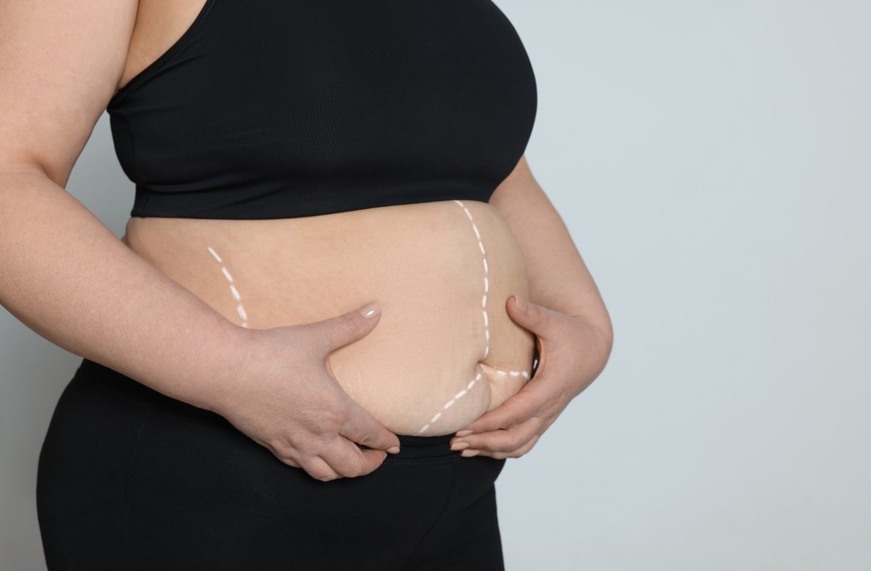 Cirurgia Bariátrica Pelo Bradesco Saúde Cobertura Essencial
